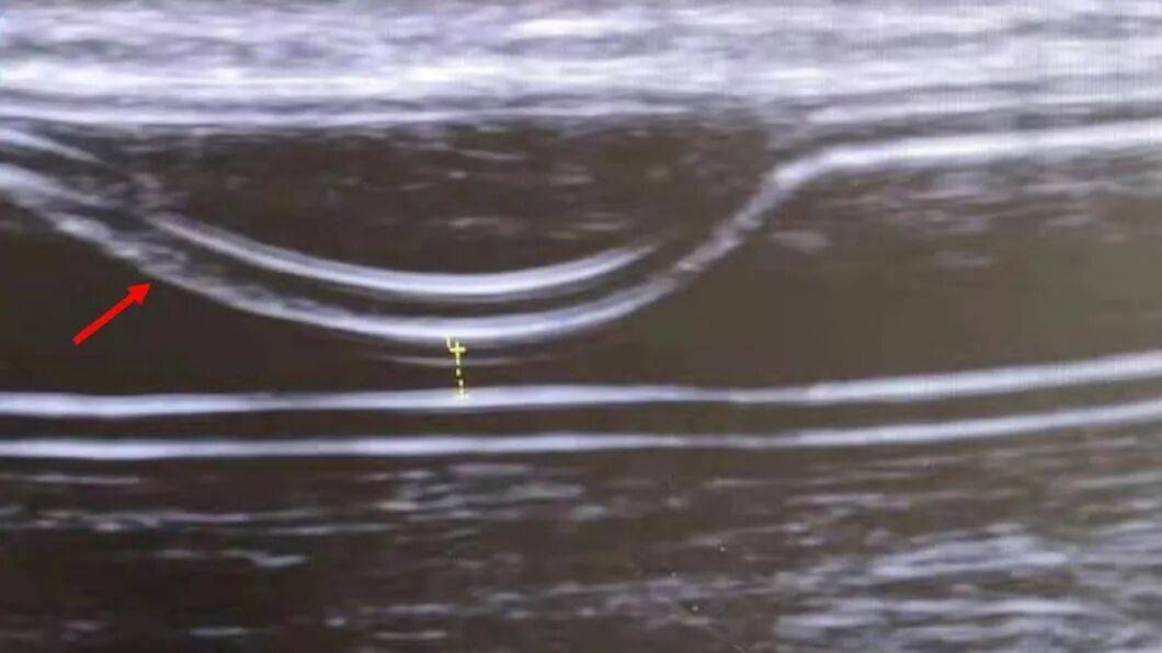 2026年首篇！我院腎臟內科在國際血透期刊再次發表SCI論文