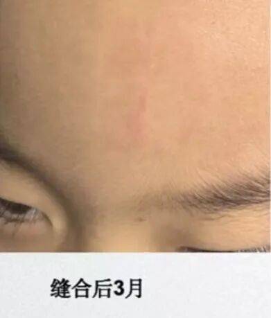 精藝·醫問 | 從王力宏的意外事故，來擺一擺“美容縫合”
